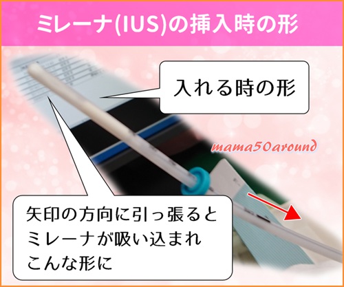 ミレーナ（IUS)を入れる時のコンパクトな形の写真